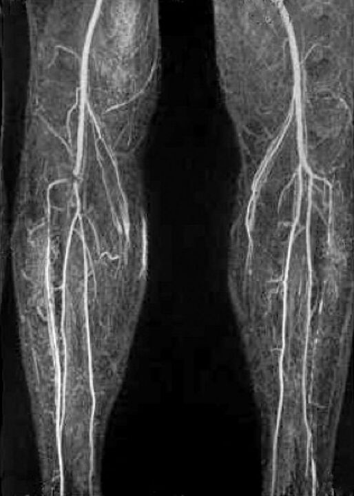 X -ray baskularra