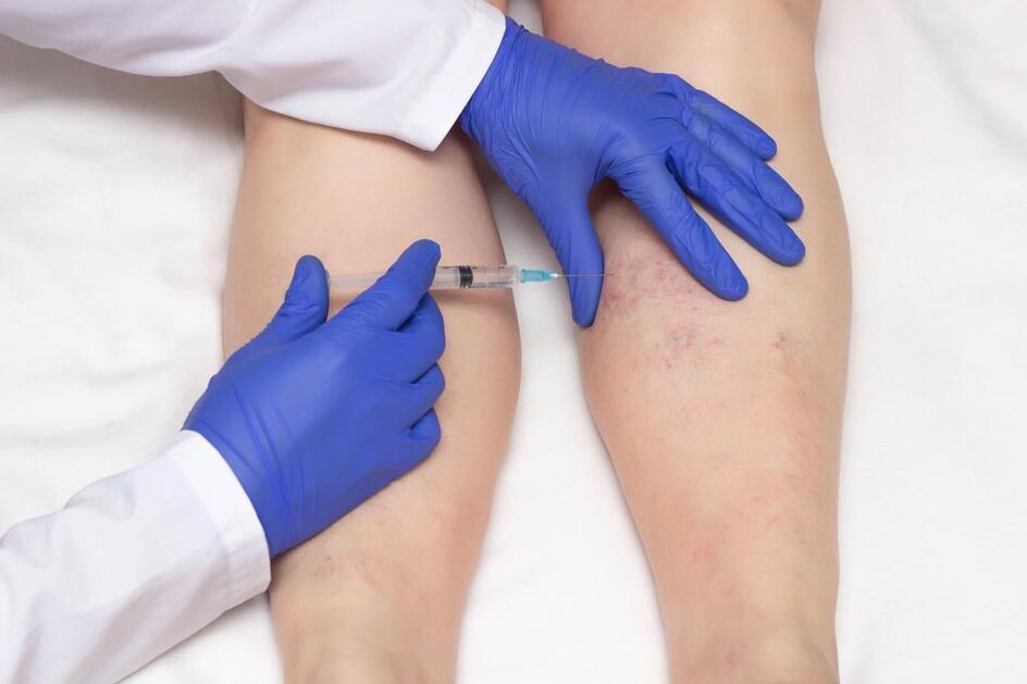 Eskleroterapia barizeak tratatzeko metodo bat da