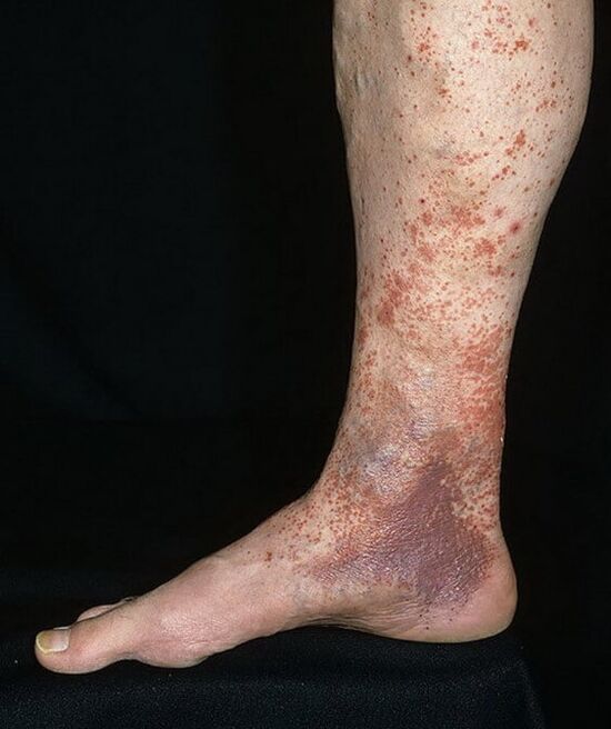 Barize dermatitisa